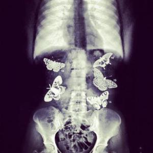 butterflies-in-stomach-xray